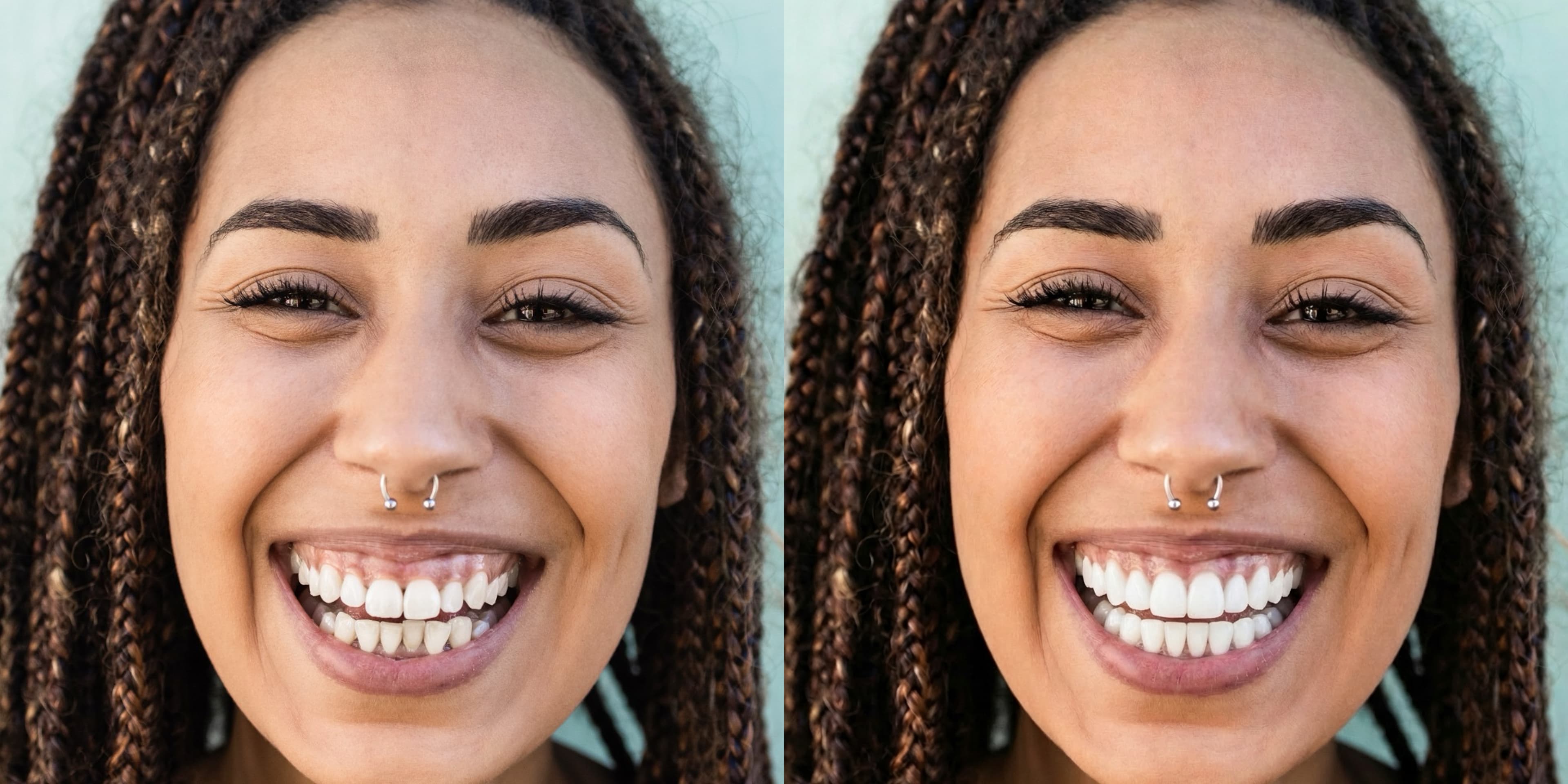 Digital Smile Simulation Preview